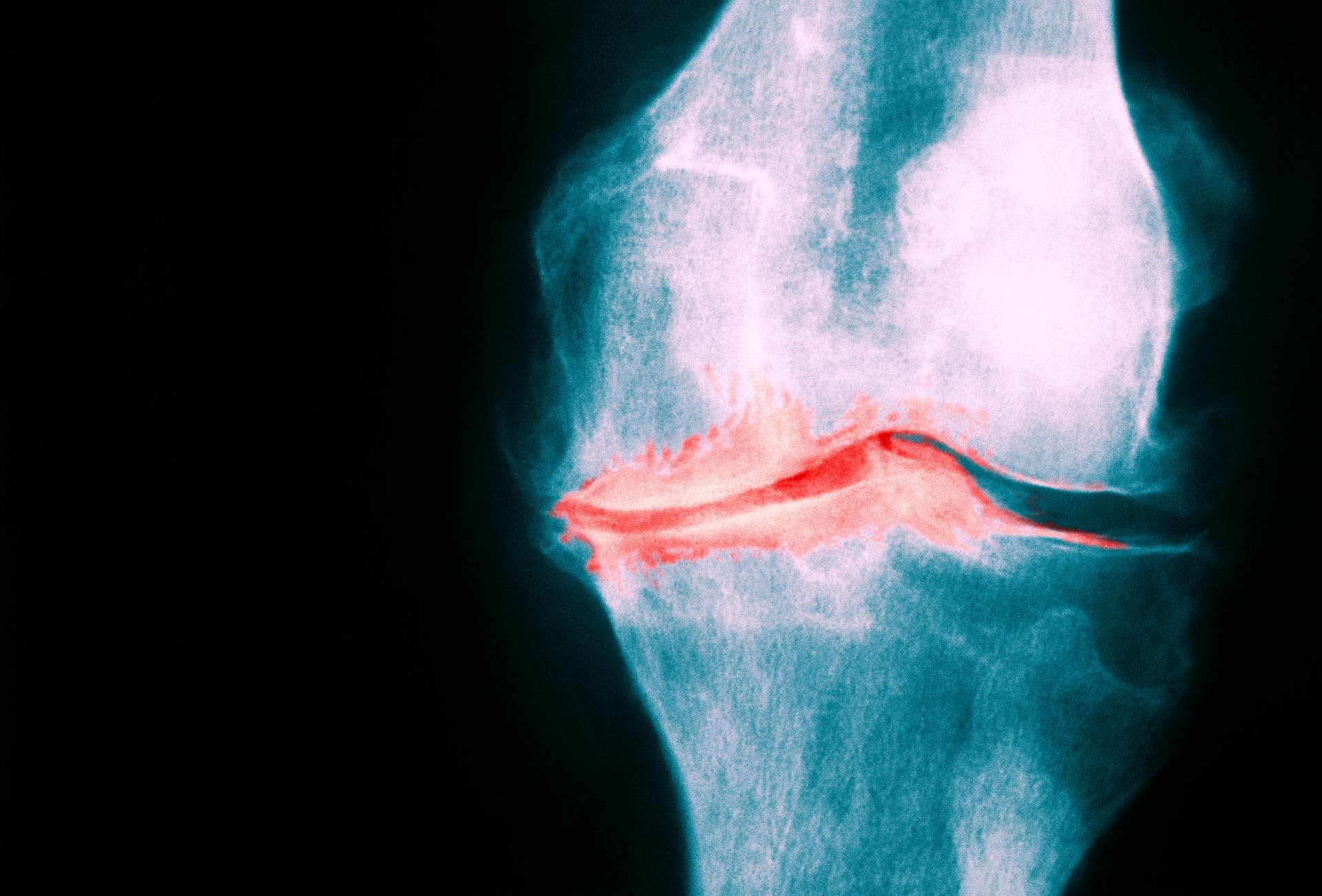 Main Routine Exercises Breakthrough Osteoarthritis Study Offers Hope Without Surgery - Men's ...